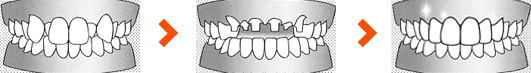 歯のガタガタ