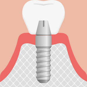 インプラント