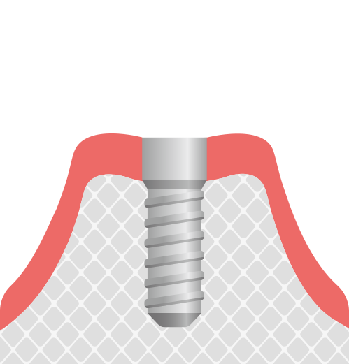 インプラント治療