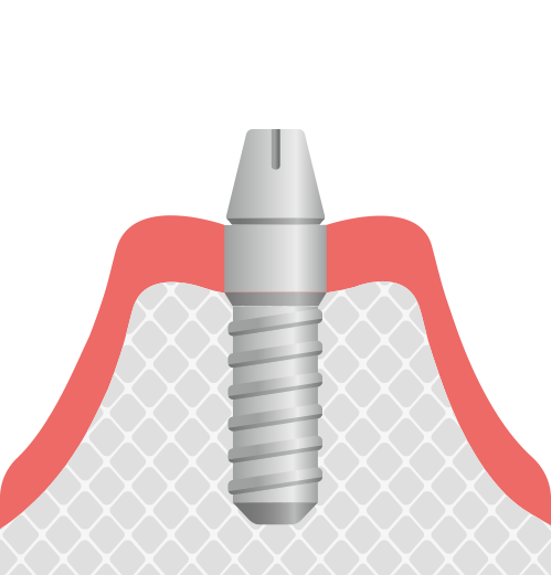 インプラント治療
