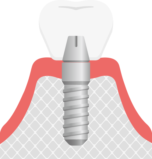 インプラント治療
