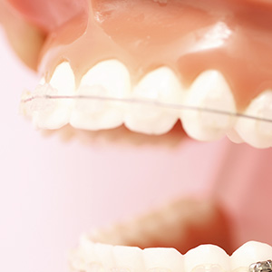 前歯部に特化した部分矯正