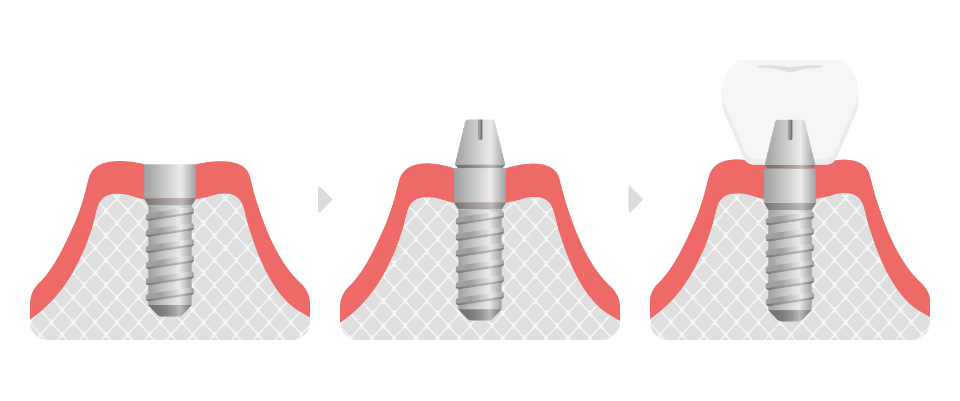 インプラント治療のイメージ