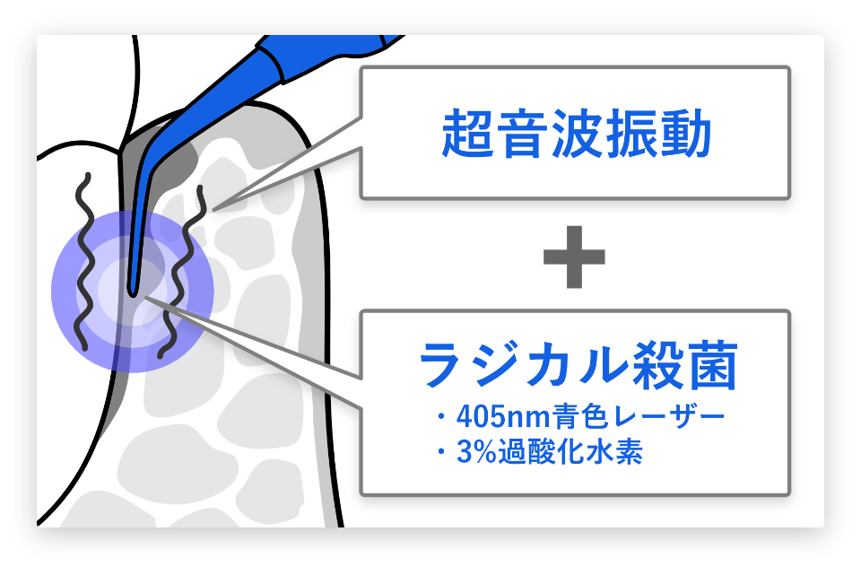 歯周ポケットの深部までしっかり除菌できる高精度の光治療